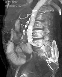 Calcification in SMA Led to Ischemia - CTisus CT Scan