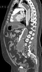 Type B Dissection With Extensive Thrombosis - CTisus CT Scan