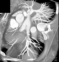 Coronary Angiography - CTisus CT Scan