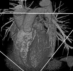 LAD Disease - CTisus CT Scan