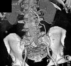 Endovascular Stent - CTisus CT Scan