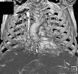 Coronary Artery Bypass Surgery - CTisus CT Scan