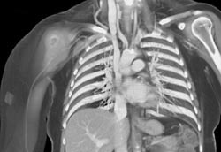 Clot in Right Subclavian Artery - CTisus CT Scan