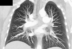 Normal Pulmonary Vasculature - CTisus CT Scan