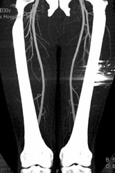 GSW Leg Without Vessel Injury - CTisus CT Scan