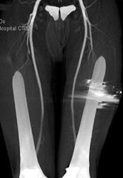 Gunshot Wound CT Angiogram - CTisus CT Scan