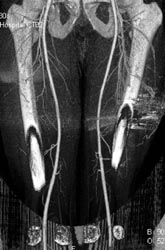 Ct Angiography of Lower Thigh - CTisus CT Scan