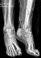 Run Off Study - CTisus CT Scan