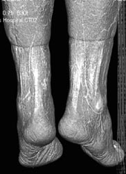 3D of Soft Tissue of the Feet From CTA - CTisus CT Scan