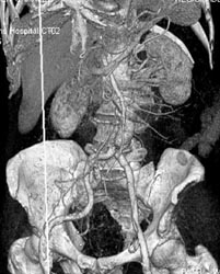 Focal Aneurysm - CTisus CT Scan