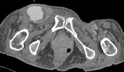 Femoral Artery Pseudoaneurysm - CTisus CT Scan