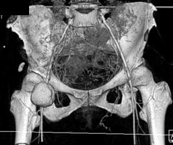 Pseudoaneurysm Using VRT - CTisus CT Scan