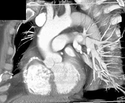 Plague and Calcification Right Coronary Artery - CTisus CT Scan