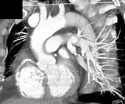 Diseased Right Coronary Artery With Nice Aortic Root - CTisus CT Scan