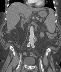 Aortic Aneurysm - CTisus CT Scan