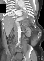 Type B Dissection - CTisus CT Scan