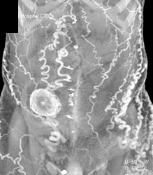 Collaterals in Abdominal Wall - CTisus CT Scan