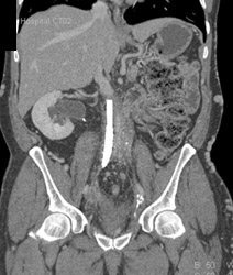 Stent in Occluded IVC With Collaterals. Process Was Retroperitoneal Fibrosis - CTisus CT Scan