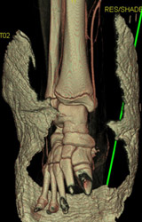 CTA of Lower Extremity - CTisus CT Scan