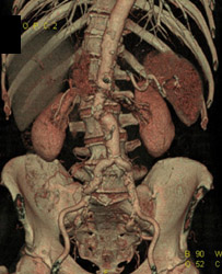 Aortic Aneurysm - CTisus CT Scan