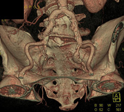 Internal Iliac Artery Aneurysm - CTisus CT Scan