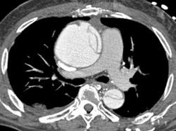 Type A Dissection - CTisus CT Scan