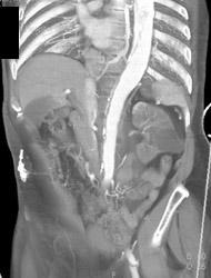 Type A Dissection - CTisus CT Scan