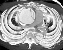 Type A Dissection - CTisus CT Scan