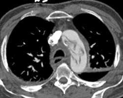 Type A Dissection - CTisus CT Scan