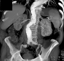 Aortic Aneurysm With Stenosis of Right Common Iliac Artery - CTisus CT Scan