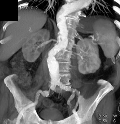 Atherosclerotic Disease Aorta With Stenosis of Right Common Iliac Artery - CTisus CT Scan