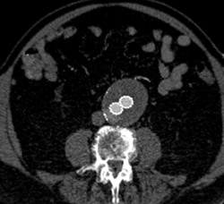 Normal Endovascular Repair - CTisus CT Scan