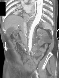 Type A Dissection - CTisus CT Scan