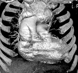 Type A Dissection - CTisus CT Scan