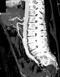 Calcified Plaque Abdominal Aorta - CTisus CT Scan