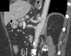 Focal Dissection in SMA - CTisus CT Scan