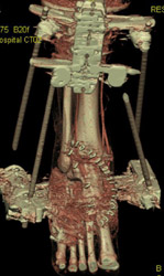 CTA for Degloving Injury - CTisus CT Scan