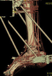 CTA for Revascularization Planning Pre-op - CTisus CT Scan