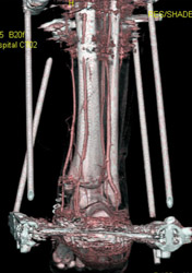 CTA for Pre-op Planning - CTisus CT Scan