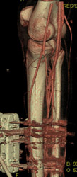 CTA at Popliteal Artery - CTisus CT Scan