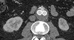 Leak From Endograft - CTisus CT Scan