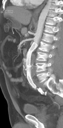 Aortic Aneurysm Repair With Stent - CTisus CT Scan