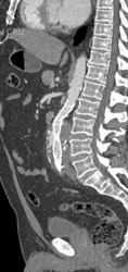 Leak From Endoluminal Repair With Stent - CTisus CT Scan