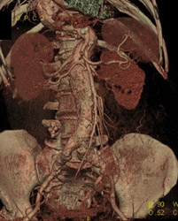 CTA of Abdominal Aortic Aneurysm - CTisus CT Scan