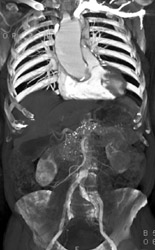 Dilated Ascending Aorta - CTisus CT Scan