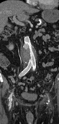 Endoleak From Stent - CTisus CT Scan