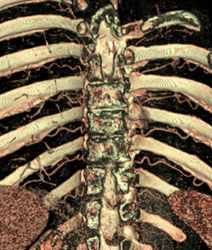 Nice Intercostal Arteries - CTisus CT Scan