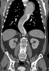 Aortic Dissection With Differential Flow in True and False Lumen - CTisus CT Scan