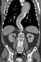 Aortic Dissection - CTisus CT Scan