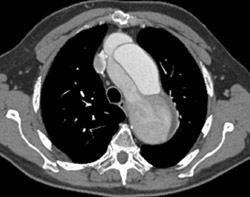 Aortic Dissection - CTisus CT Scan